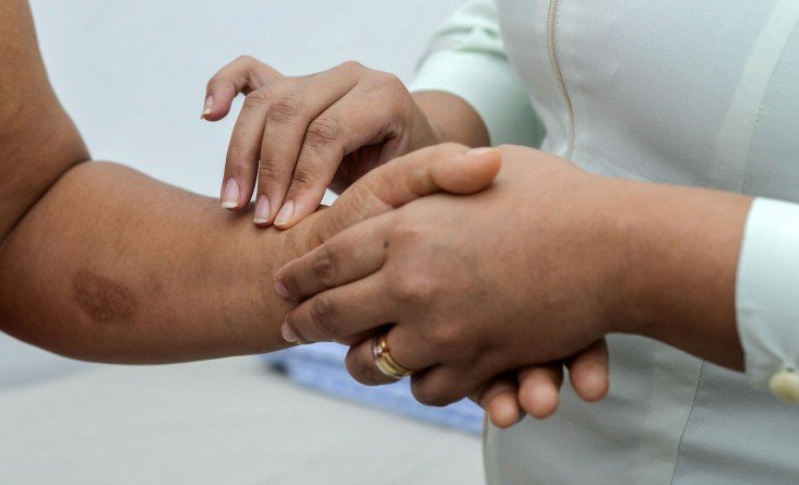 Governo do Tocantins amplia ações preventivas contra hanseníase no Janeiro Roxo.